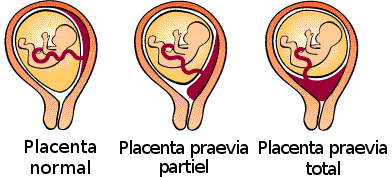 placenta-praevia