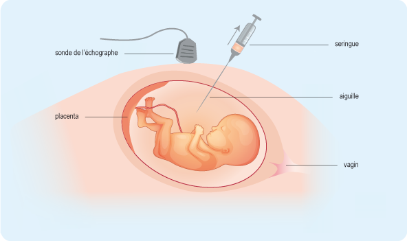 L’amniocentèse