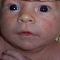 acné de bébé